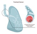 Tracheal cancer. Pathological malignant cells or tumor located in windpipe