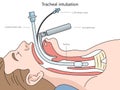 Tracheal intubation diagram medical science