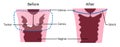 Trachelectomy - surgery removal of the cervix. Medical vector illustration marked with lines. Before and after. Stitch