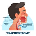 Tracheostomy cross section diagram, vector illustration Royalty Free Stock Photo