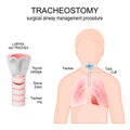 Tracheostomy. Anatomy of the trachea with stoma. larynx Royalty Free Stock Photo