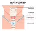 Tracheostomy. Tracheal surgery neutralise airway obstruction. Plastic cannula