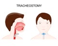 Tracheotomy. side view of the neck and placement of a tracheostomy tube Royalty Free Stock Photo