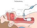 Tracheotomy structure diagram medical science Royalty Free Stock Photo