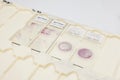 Traditional and liquid based cytology microscope slides for pap smear test. Cervical cancer concept. Medical concept