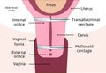 Transabdominal cerclage tightening of cervix opening during pregnancy. Anatomy of cervix, McDonald cerclage. uterus with