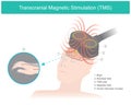 Transcranial Magnetic Stimulation TMS.