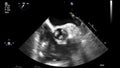 High quality transesophageal ultrasound video in grey mode.