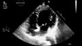 High-quality video ultrasound transesophageal examination of the heart.