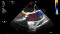 Ultrasound transesophageal examination of the heart.