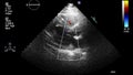 Ultrasound transesophageal examination of the heart.