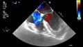 Ultrasound transesophageal examination of the heart.