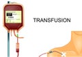 transfusion of donor blood to the patient through the subclavian catheter Royalty Free Stock Photo