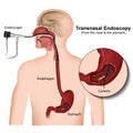 Transnasal endoscopy medical illustration on white background