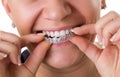 Transparent teeth braces Royalty Free Stock Photo
