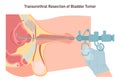 Transurethral resection of the bladder tumor. Male bladder benign