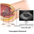 Transvaginal ultrasound checkup 3d medical illustration on white background