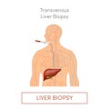 Transvenous liver biopsy