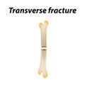 Transverse bone fracture. Infographics. Vector illustration on a lined background.