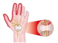 Transverse carpal ligament Royalty Free Stock Photo