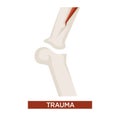 Trauma health damage with bone fracture close up