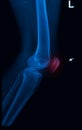 Trauma knee joint x-rays image Royalty Free Stock Photo