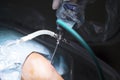Traumatology orthopedic surgery knee arthroscopy drip