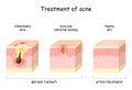 Treatment of acne. Skin layers Before and after therapy