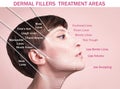 Treatment areas for anti-wrinkle injection Royalty Free Stock Photo