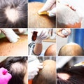 Treatment of baldness with beauty injections. Cosmetologist hands in gloves make a subcutaneous injection. Plasmalifting