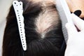 Treatment of baldness with beauty injections. Cosmetologist`s hands in gloves make a subcutaneous injection.