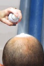 Treatment of baldness with beauty injections. Mesotherapy. Plasmalifting. Royalty Free Stock Photo