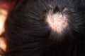 Treatment of baldness with beauty injections.