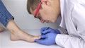 A dermatologist cleans a nail affected by a fungus. Antimycotic therapy. Treatment of candidiasis and assistance to patients with