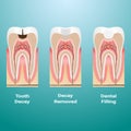 Treatment Of Caries. Dental Filling. Dental Caries Detailed Isolated On A Background. Vector Illustration.