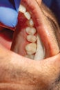 Treatment of caries of a human tooth close-up. The concept of de