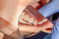 Treatment of caries of a human tooth close-up. The concept of de