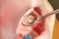 Treatment of caries of a human tooth close-up. The concept of de