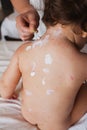 Treatment for chicken pox Royalty Free Stock Photo