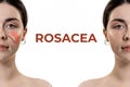 Treatment of couperose. Two half female portraits showing the result of treatment. White background with ROSACEA text Royalty Free Stock Photo