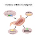 Treatment of Helicobacter pylori. Medications. Antacids, proton pump blockers and H2-histamine blockers. Infographics