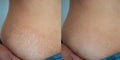 Before and after treatment Imperfect Skin problem stretch marks on woman body