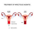 Treatment Of Infectious Vaginitis