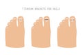 Treatment of ingrown toenail with titanium brackets different types. Hand drawn vector illustration