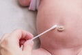 Treatment of newborn baby navel with a cotton swab.