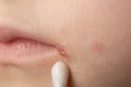 Treatment with ointment for a dermatological disease in the corners of the mouth and lips of a little girl. Treatment of