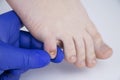 Doctor podologist examines the fungus of the nail on the womanÃ¢â¬â¢s foot. Treatment of onychomycosis, mycosis. Deformed nail plate