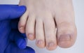Doctor podologist examines the fungus of the nail on the womanÃ¢â¬â¢s foot. Treatment of onychomycosis, mycosis. Deformed nail plate