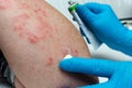 Treatment of psoriasis. A gloved doctor applies a medicated ointment to a patient s diseased skin