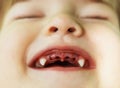 Treatment and removal of teeth in children. Close-up of a beautiful little girl lying at home showing her mouth with her baby teet